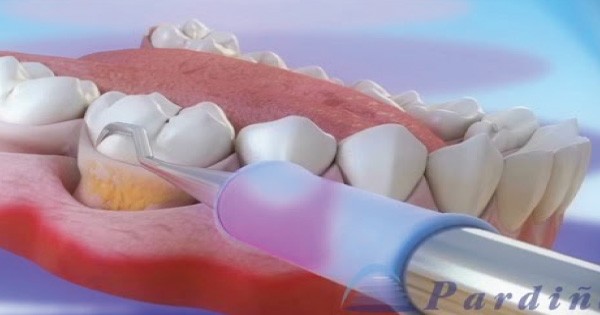 Dental Health Providers Clinics - Dental Scaling Specialists in Nairobi