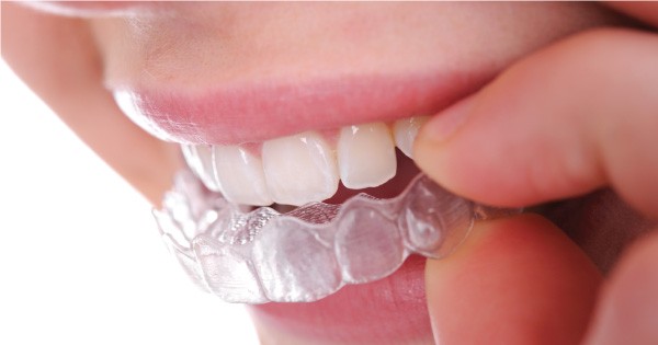 Molars Dental Practice - Customised Removable Aligners For Realigning Your Teeth