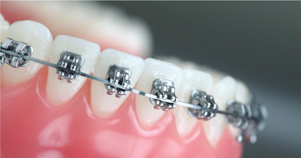 Swedish Dental Clinic, SDC - Get Orthodontic Treatment From Swedish Dental