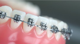 Swedish Dental Clinic, SDC - Get Orthodontic Treatment From Swedish Dental