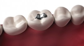 Swedish Dental Clinic, SDC - Dental Filling To Restore A Tooth Damaged By Decay
