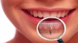 Dental Health Providers Clinics - Teeth Implant Clinic In Nairobi, Kenya