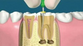 Molars Dental Practice - Root Canal Treatment in Kenya