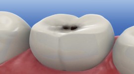 Swedish Dental Clinic, SDC - 6 Tips On How To Prevent Dental Caries 