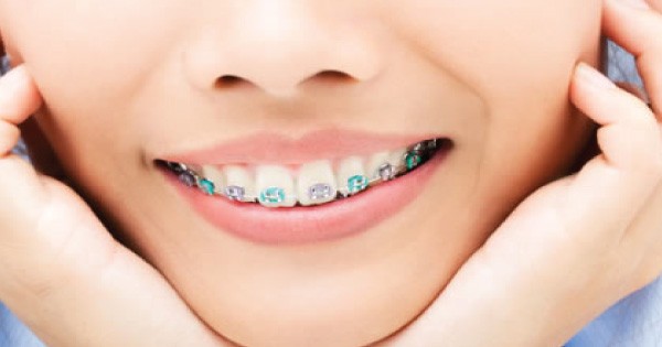 Balm Dental Care Centre  - Dental Braces For Adults 