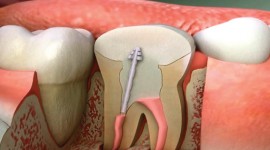 Smile Africa - Root Canal Treatment in Kenya