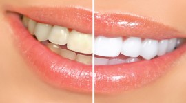 Family Dentistry - Professional Teeth Whitening Services in Kenya