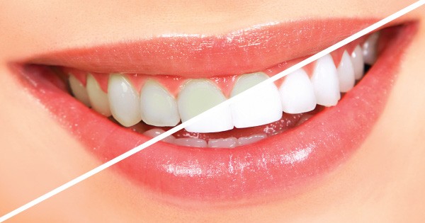 Swedish Dental Clinic, SDC - Dentists Offering The Best Teeth Whitening Services In Nairobi, Kenya