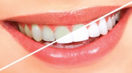 Swedish Dental Clinic, SDC - Dentists Offering The Best Teeth Whitening Services In Nairobi, Kenya