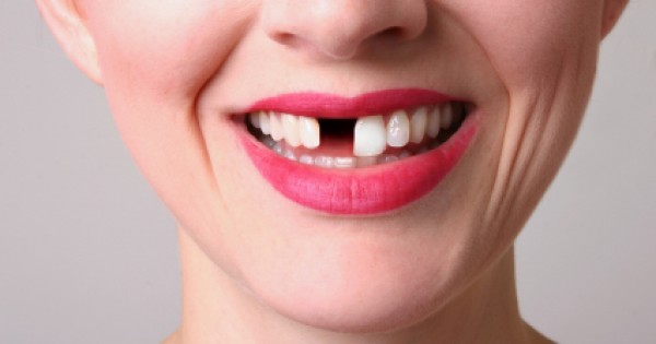 Smile Africa - Dentists Dealing With Missing Teeth In Kenya