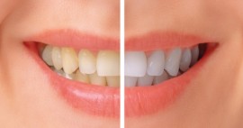 Molars Dental Practice - Teeth Whitening Dental Service in Nairobi, Kenya