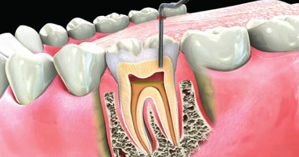 Swedish Dental Clinic, SDC - Professional Root Canal Treatment in Kenya