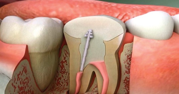Dental Health Providers Clinics - Root Canal Treatment in Nairobi, Kenya 