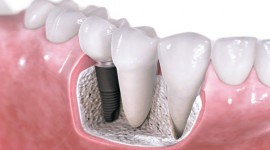 Family Dentistry - Dentists Offering Professional Dental Implants in Kenya