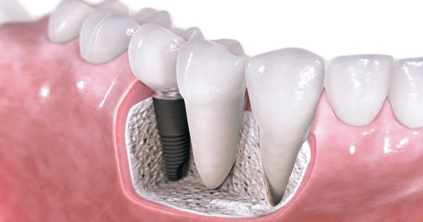 Family Dentistry - Dentists Offering Professional Dental Implants in Kenya