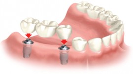 Molars Dental Practice - Dentists Offering The Best Dental Bridging Services In Kenya