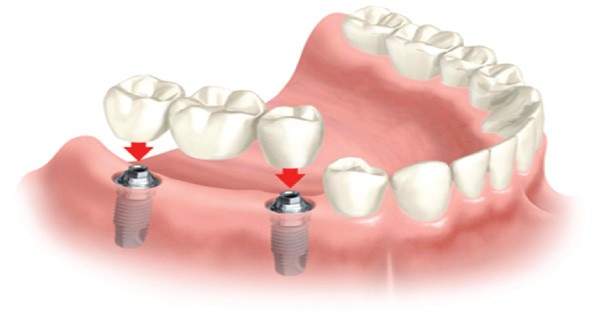Molars Dental Practice - Dentists Offering The Best Dental Bridging Services In Kenya