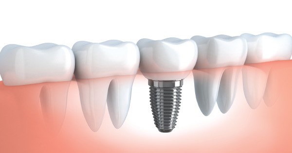 Smile Africa - Professional Dental Implants Services in Kenya