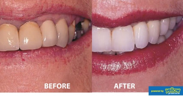 Smile Africa - The Best Dental Crown Clinic In Kenya