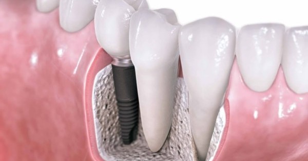 Balm Dental Care Centre  - Root Canal Treatment in Kenya