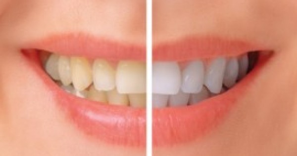 Molars Dental Practice - Teeth whitening Services in Kenya