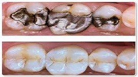 Molars Dental Practice - Dental Filling Services in Kenya