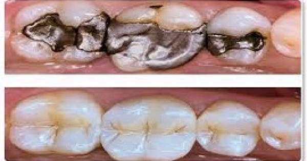 Molars Dental Practice - Dental Filling Services in Kenya