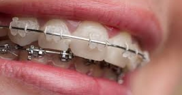 Dental Health Providers Clinics - Reliable Orthodontic Services in Nairobi, Kenya