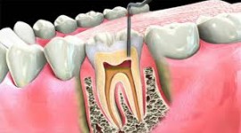 Balm Dental Care Centre  - The Best Root Canal Therapy in Nairobi, Kenya