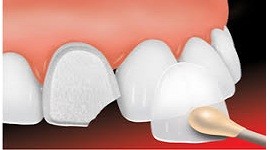 Molars Dental Practice - Dental Veneer Services in Kenya