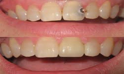 Family Dentistry - Dental Veneers Installation in Nairobi, Kenya