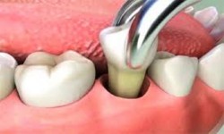Molars Dental Practice - Tooth Extraction Services in Nairobi