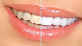Cape Dental Clinic - Teeth Whitening And Bleaching