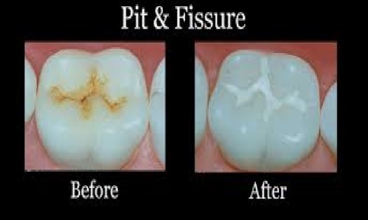 Balm Dental Care Centre  - Fissure Sealants in Nairobi