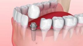 Balm Dental Care Centre  - Tooth Replacement in Nairobi