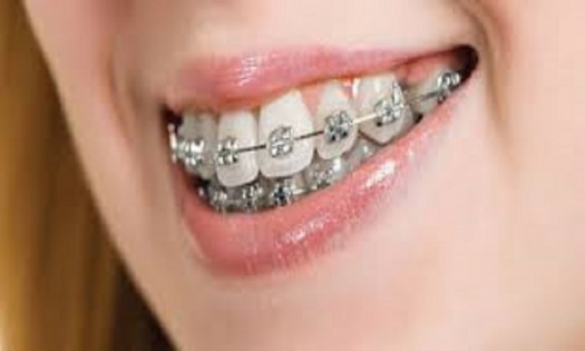 Balm Dental Care Centre  - How much do braces cost in Nairobi