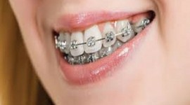 Balm Dental Care Centre  - How much do braces cost in Nairobi