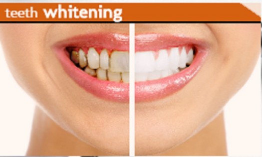 Balm Dental Care Centre  - Teeth Whitening Cost in Nairobi, Kenya