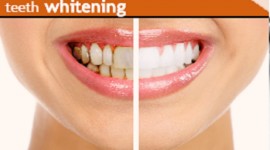Balm Dental Care Centre  - Teeth Whitening Cost in Nairobi, Kenya