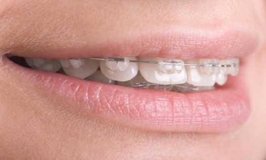 All Smiles Dental Practice - Dental Braces Specialists in Nairobi, Kenya