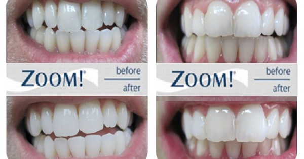 All Smiles Dental Practice - Zoom Teeth Whitening in Nairobi, Kenya