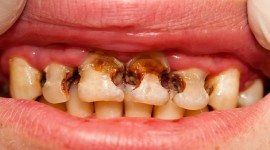 Swedish Dental Clinic, SDC - Treatment of Tooth Decay in Nairobi