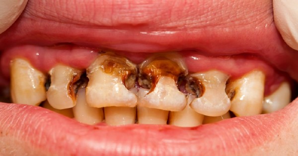Swedish Dental Clinic, SDC - Treatment of Tooth Decay in Nairobi