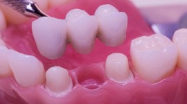 Swedish Dental Clinic, SDC - Tooth Filling in Nairobi
