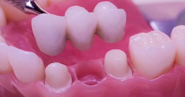 Swedish Dental Clinic, SDC - Tooth Filling in Nairobi