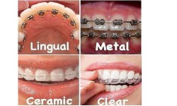 Dove Dental Clinic - Braces Specialists in Thika