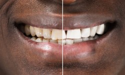 All Smiles Dental Practice - Price of Tooth Whitening in Nairobi