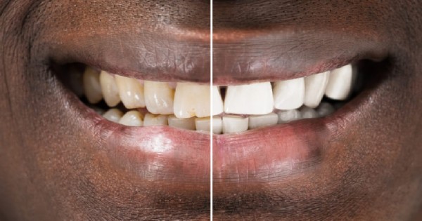 All Smiles Dental Practice - Price of Tooth Whitening in Nairobi