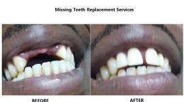 Balm Dental Care Centre  - Missing Teeth Replacement in Nairobi