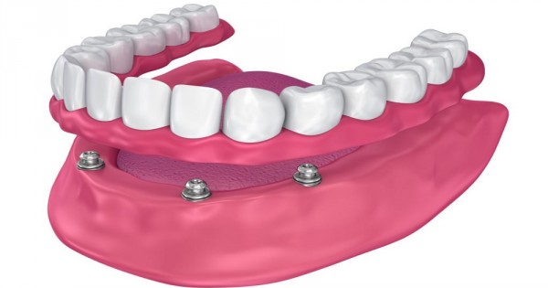 Swedish Dental Clinic, SDC - Cost of Dental Implants in Kenya